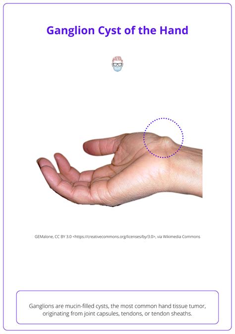 icd 10 code for right wrist ganglion cyst|2025 ICD